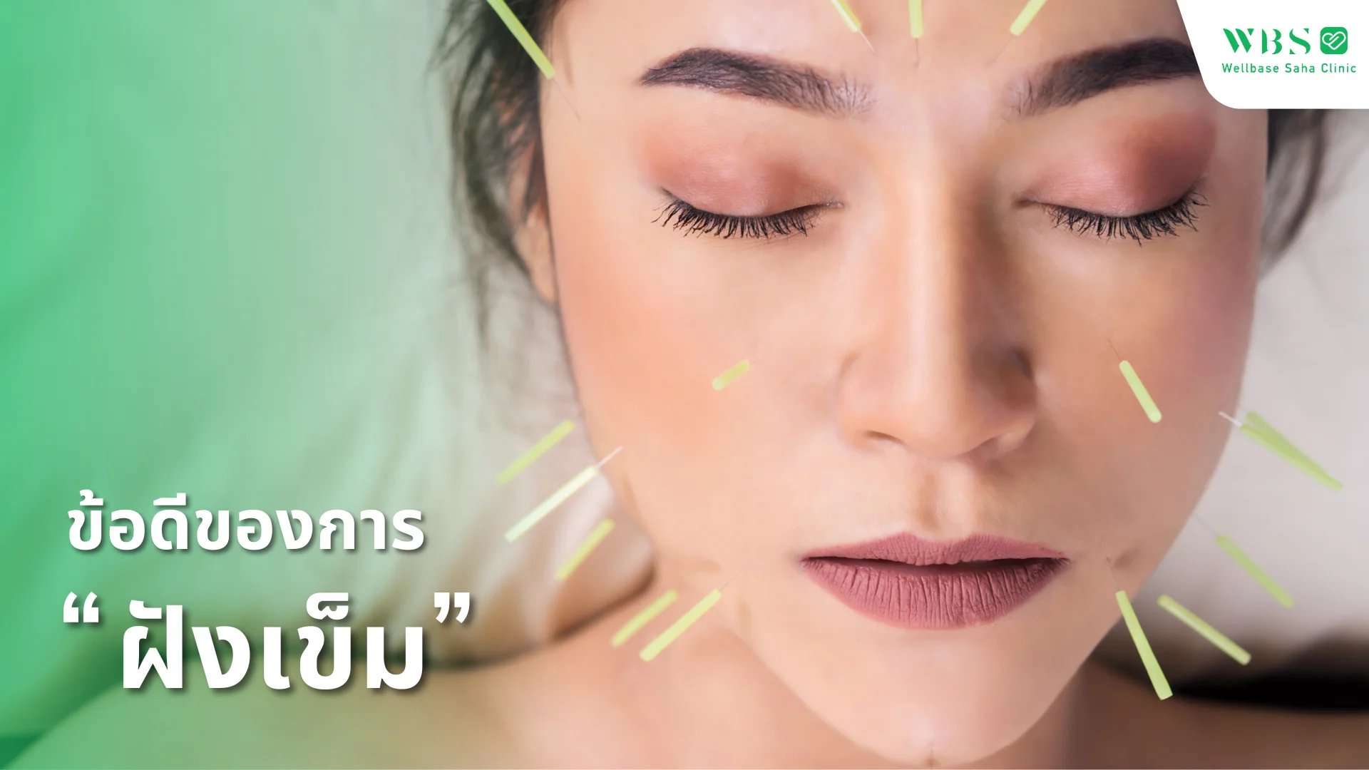 ข้อดีของการฝังเข็ม