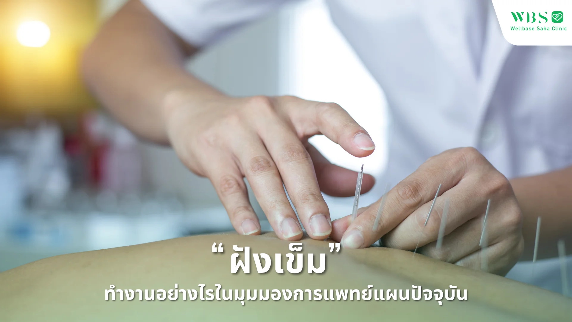“ฝังเข็ม” ทำงานอย่างไรในมุมมองการแพทย์แผนปัจจุบัน