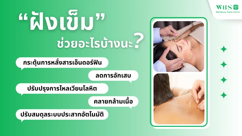 ฝังเข็ม